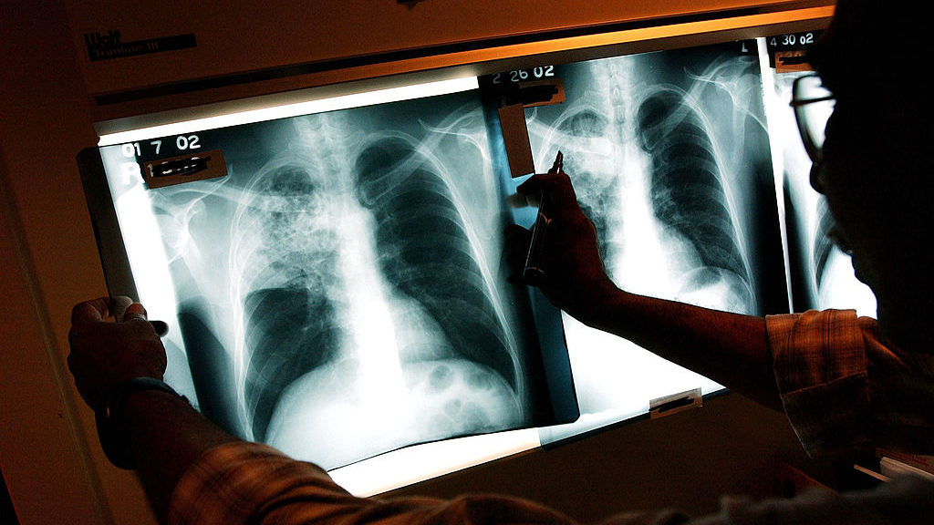 2 active tuberculosis cases traced to San Francisco strip club — KTVU FOX 2 Bay Area, Sausalito Health news